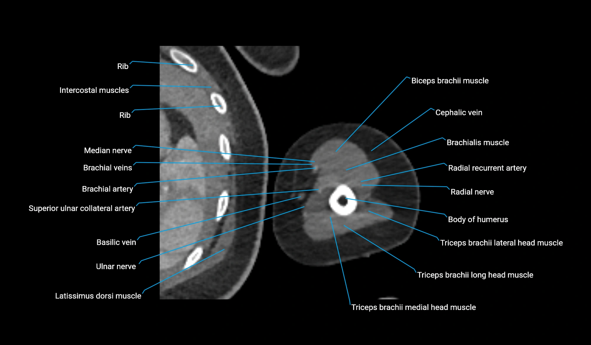 CT upper arm axial  cross sectional anatomy labelled radiology image -00298.webp